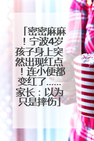 密密麻麻！宁波4岁孩子身上突然出现红点！连小便都变红了……家长：以为只是摔伤